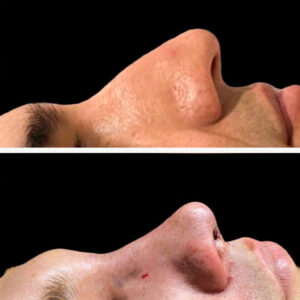 rinoplastia