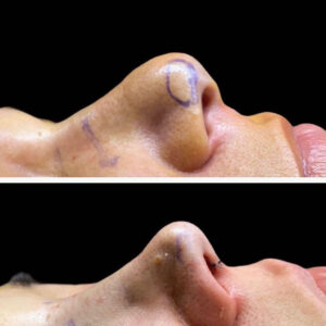 rinoplastia