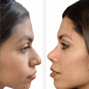 rinoplastia