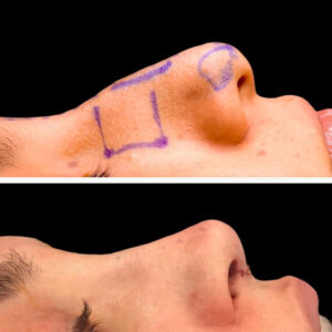 rinoplastia