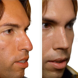 rinoplastia