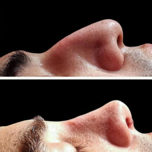 rinoplastia